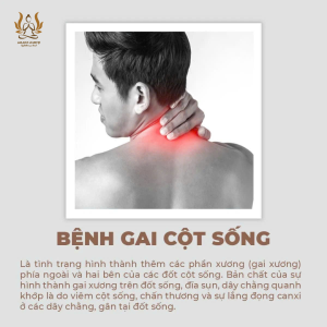Gai Cột Sống & Đau Thần Kinh Tọa: Hiểu Đúng Để Trị Liệu Tận Gốc (Không Xâm Lấn) 2026